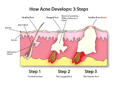 How Acne Developes:  3 Steps by Dr. David MacKoul